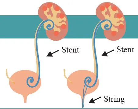 ureteral stentin iş prinsipi