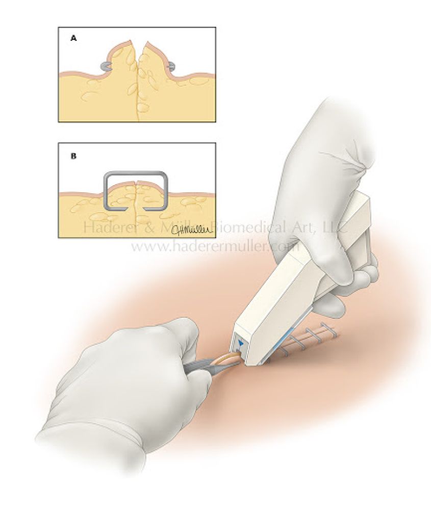 Dəri steplerinin iş prinsipi